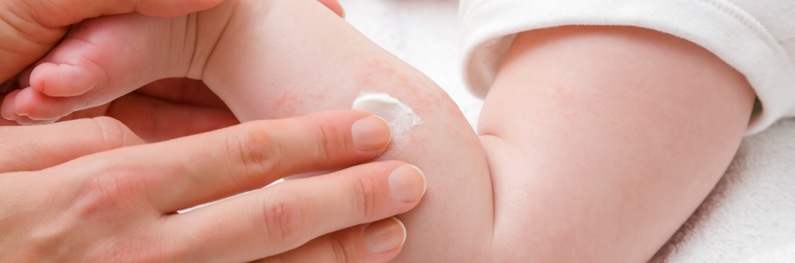 Eczema bébé